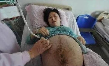 大肚美人生产双胞胎，药物不是唯一选择，可以尝试其他方法